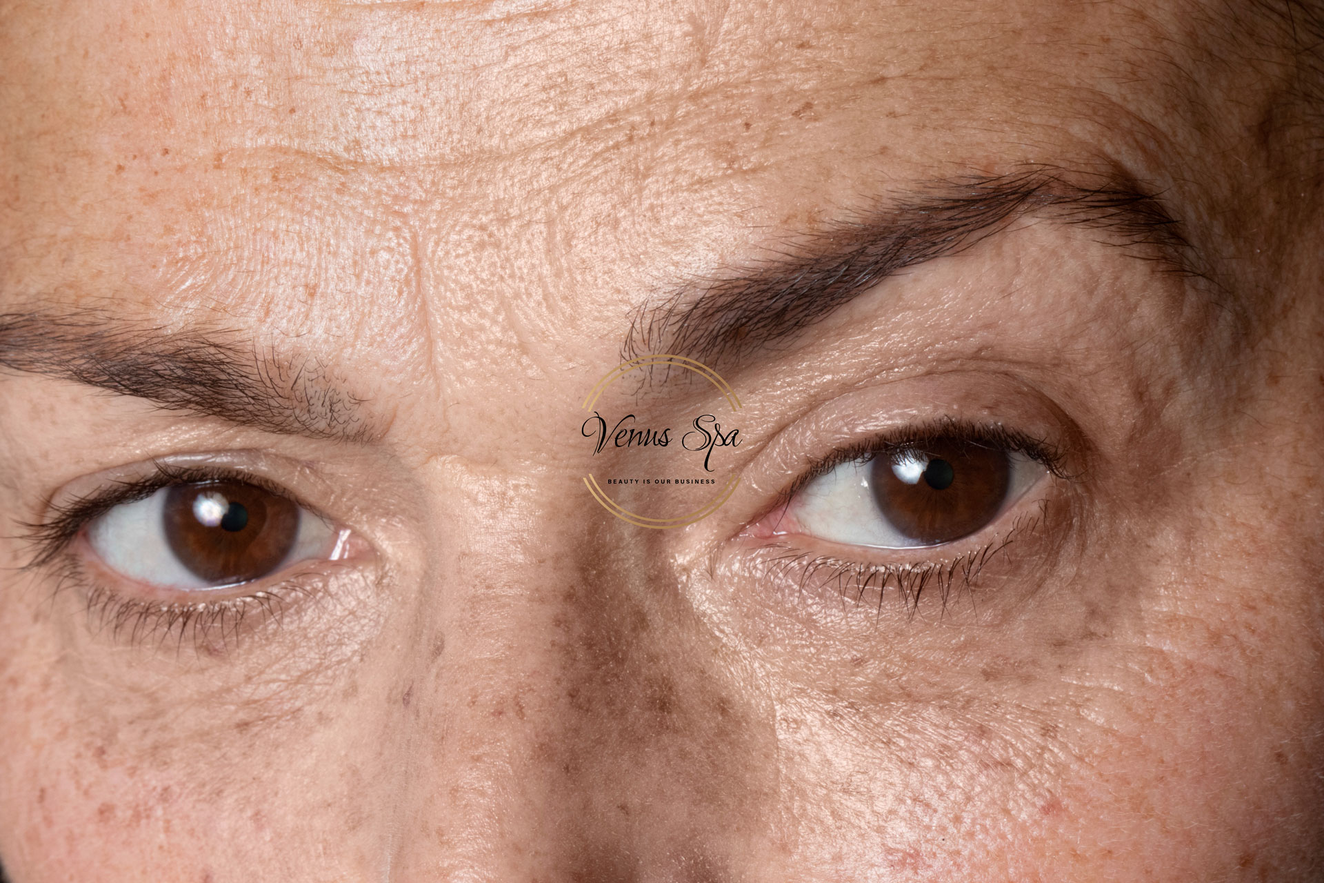 dry skin