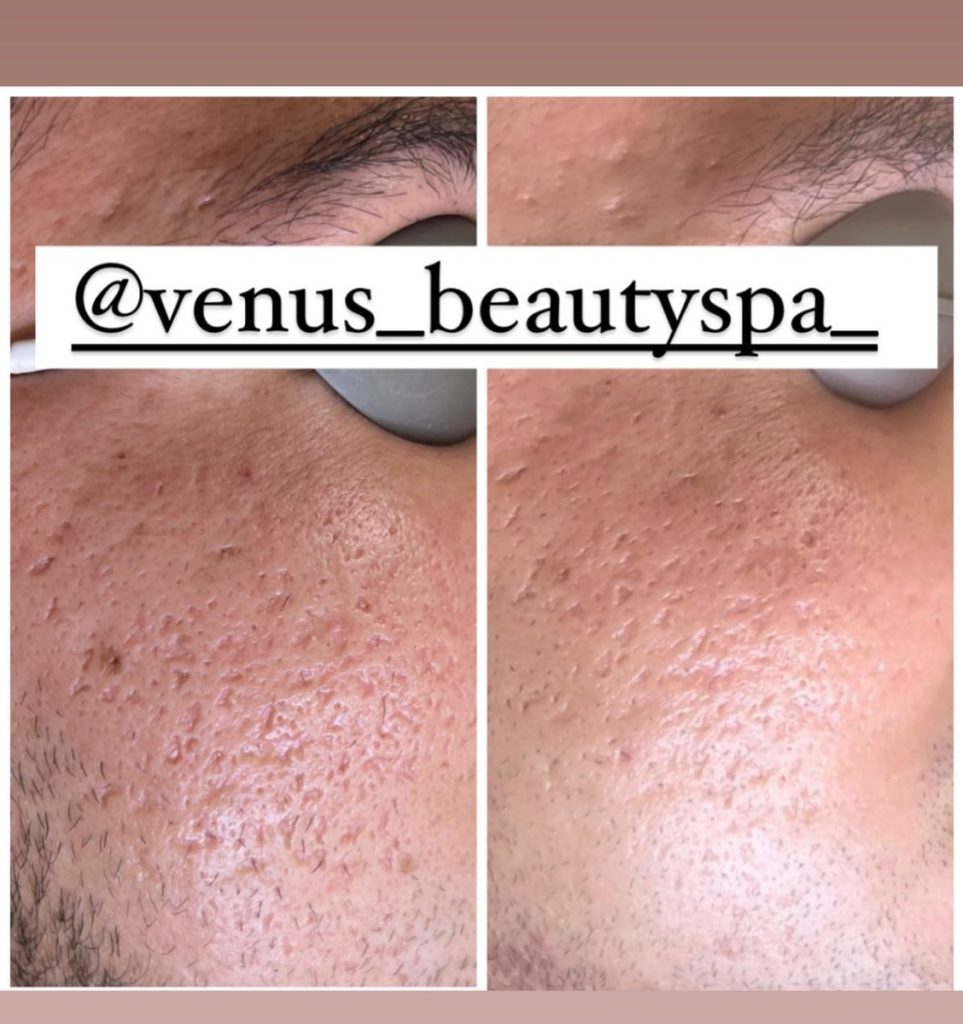 acne scars before after