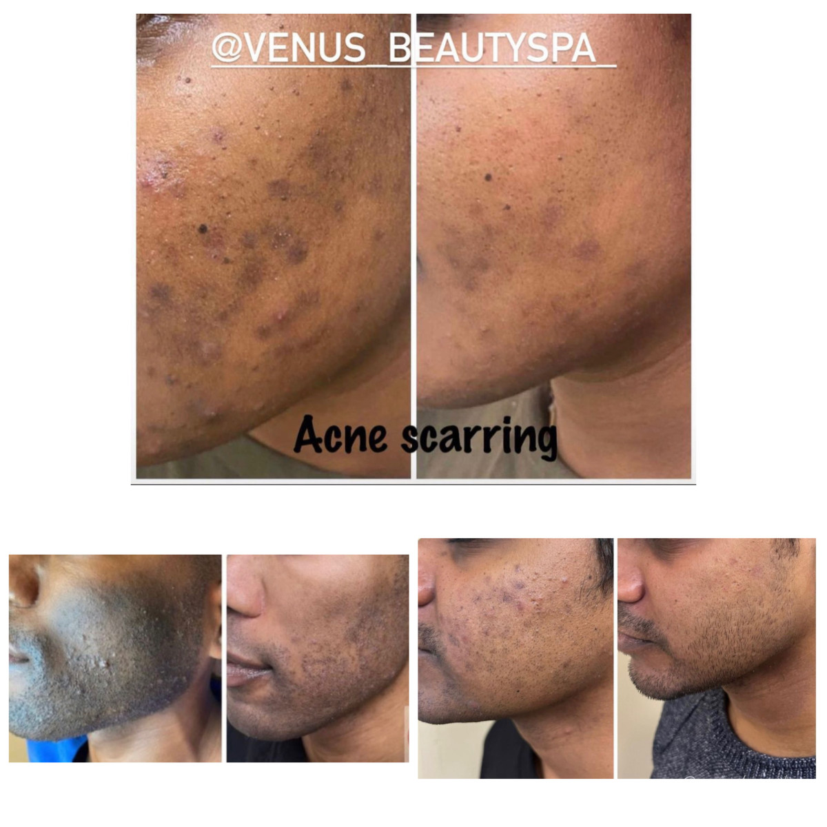 Close-up image showcasing the effects of a Enlighten Peel, revealing smoother skin , reduced acne scars and minimized hyperpigmentation