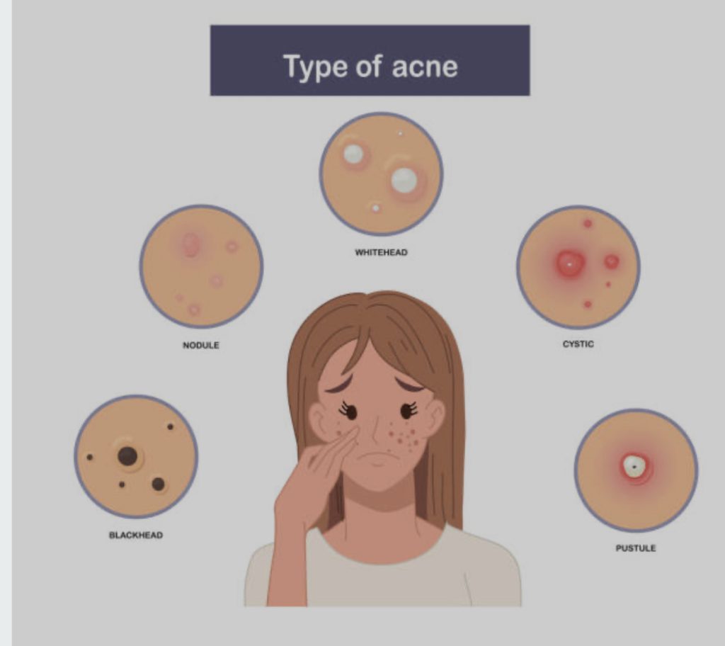 Acne starts with clogged pores, leading to blackheads and whiteheads. As inflammation increases, red pimples and pustules appear, progressing to painful cysts in severe cases. Hormonal changes often trigger breakouts along the jawline, and even after acne clears, scars and dark spots may remain.