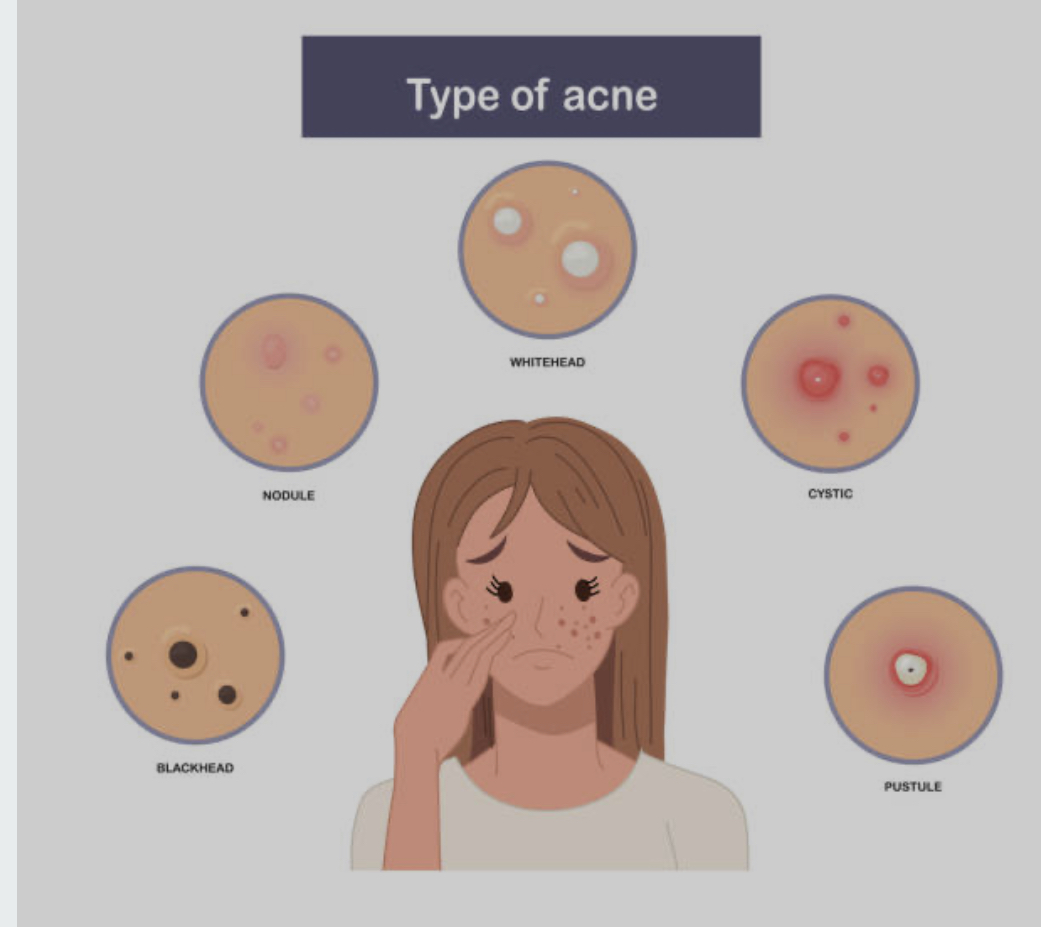 Acne starts with clogged pores, leading to blackheads and whiteheads. As inflammation increases, red pimples and pustules appear, progressing to painful cysts in severe cases. Hormonal changes often trigger breakouts along the jawline, and even after acne clears, scars and dark spots may remain.