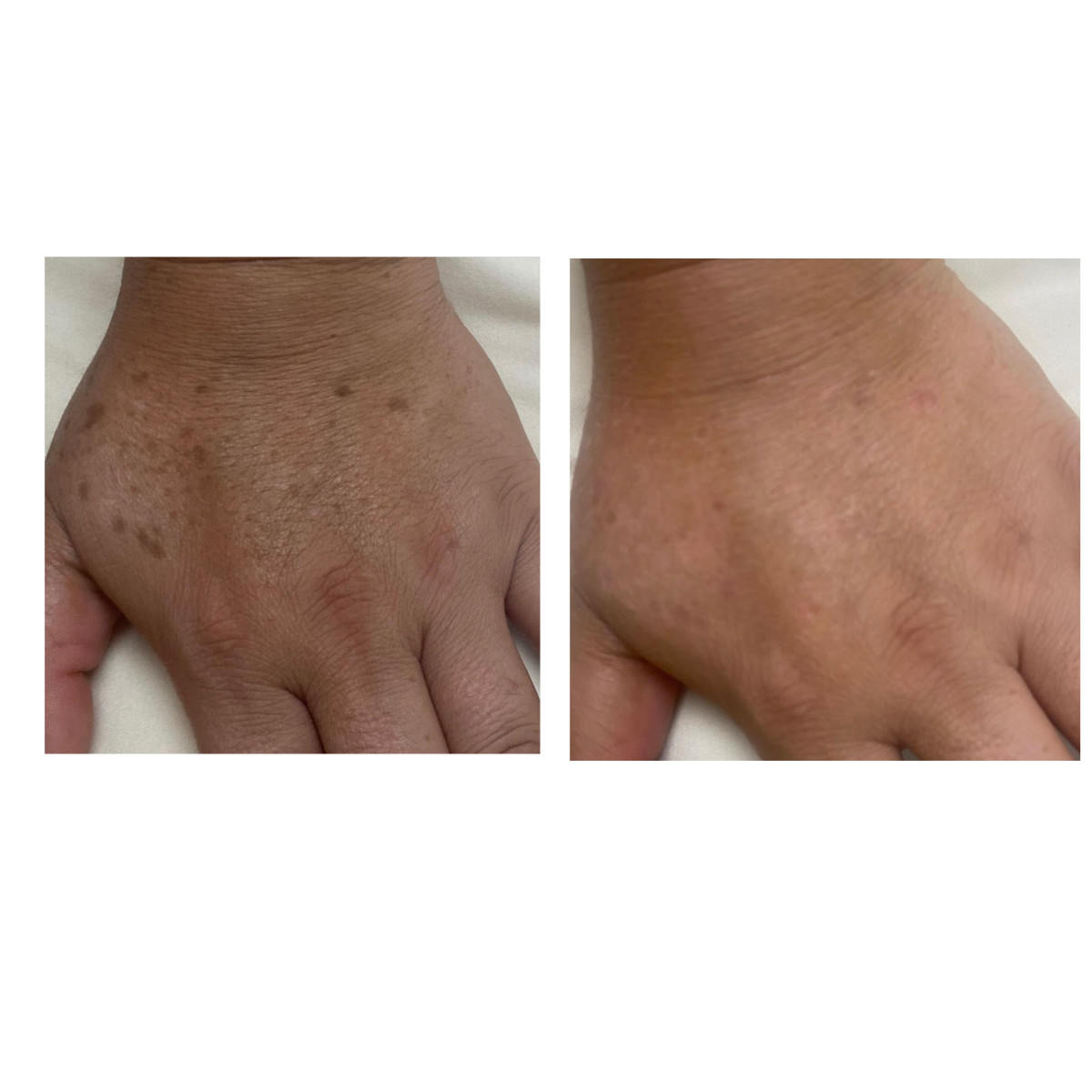 The Enlighten Peel is a medical-grade chemical peel designed to target pigmentation issues and improve overall skin texture. It’s highly effective yet gentle on the skin.
