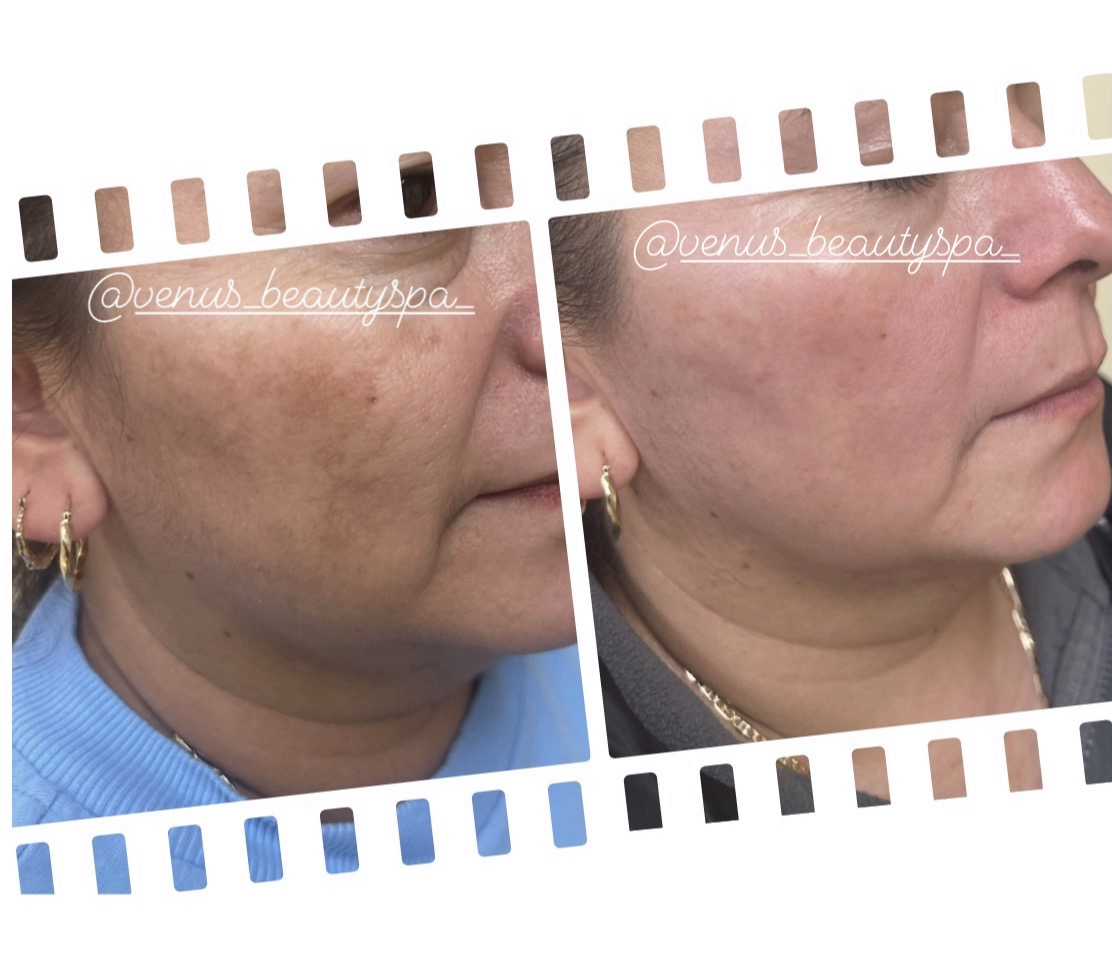 before & after treatment