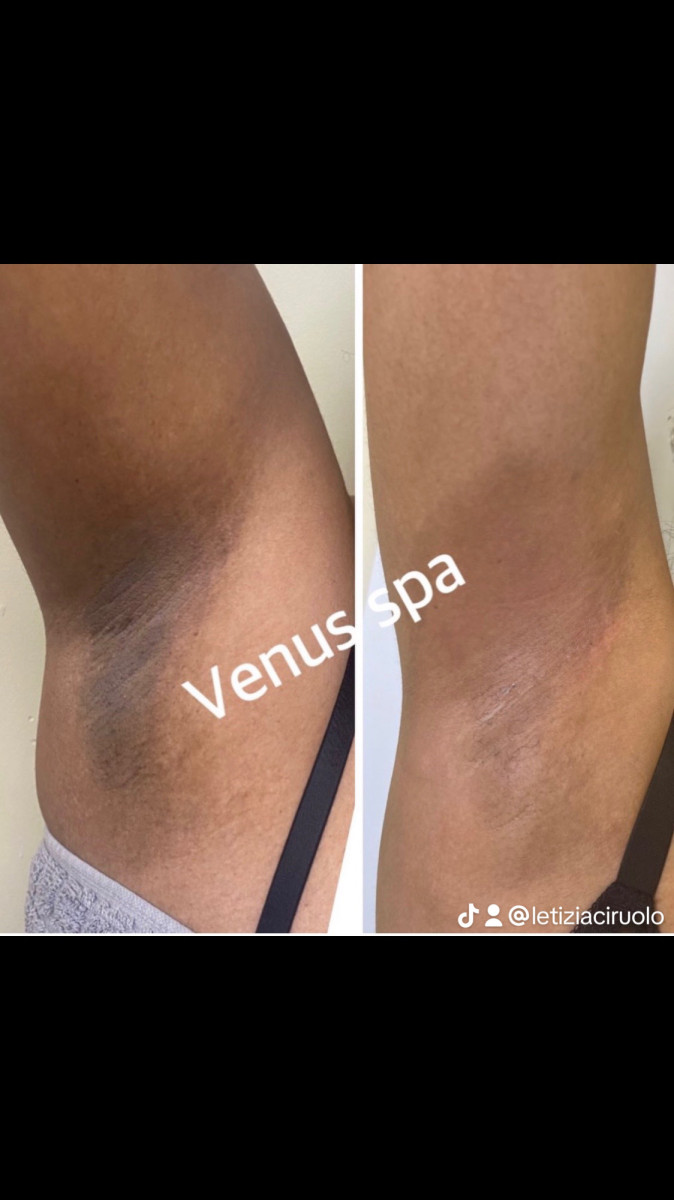 Body chemical peel treatment for smoother, brighter skin at Venus Spa