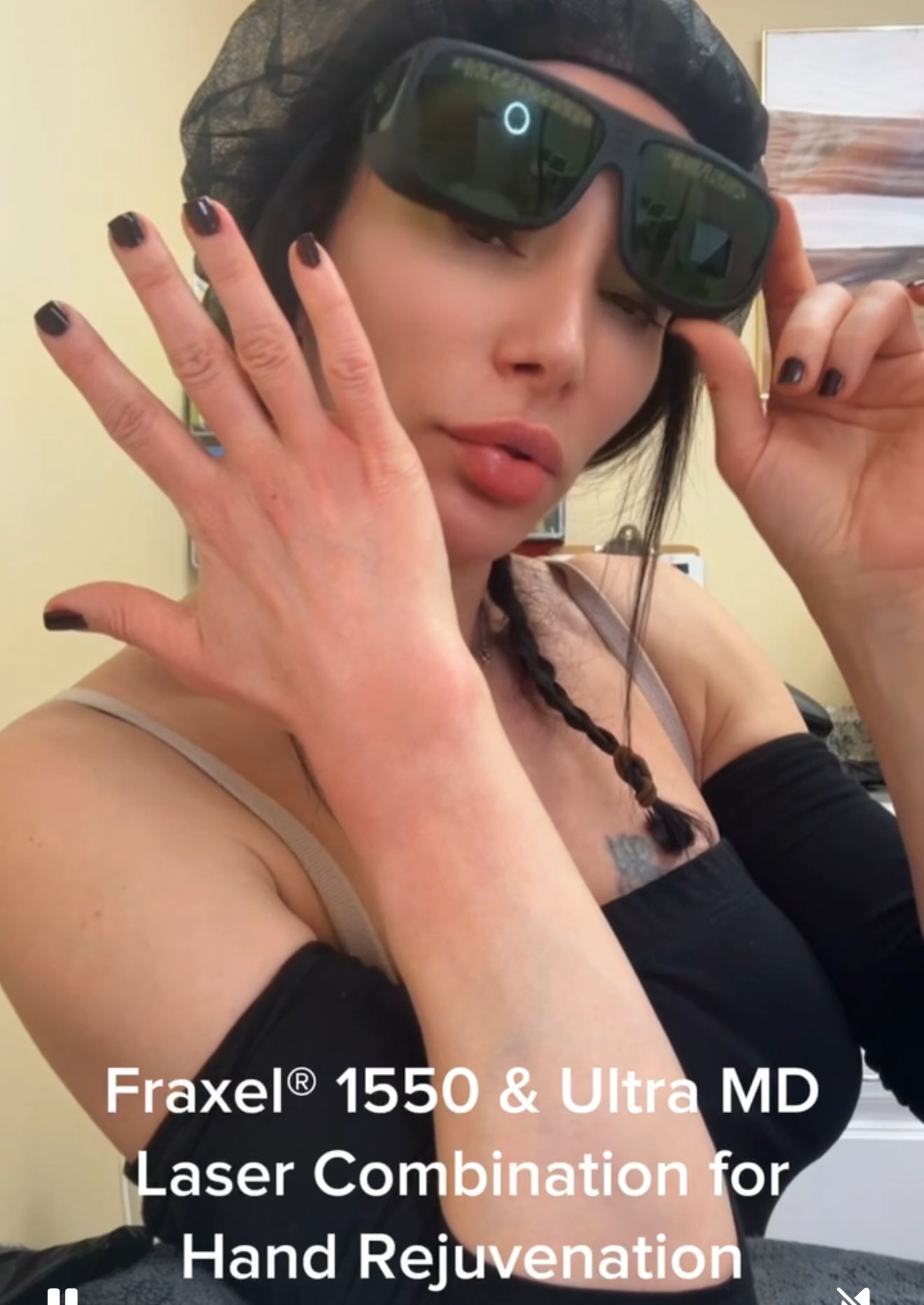 Fraxel laser 1550 and ultra MD LASER TREATMENT for hand’s rejuvenation at Venus Spa