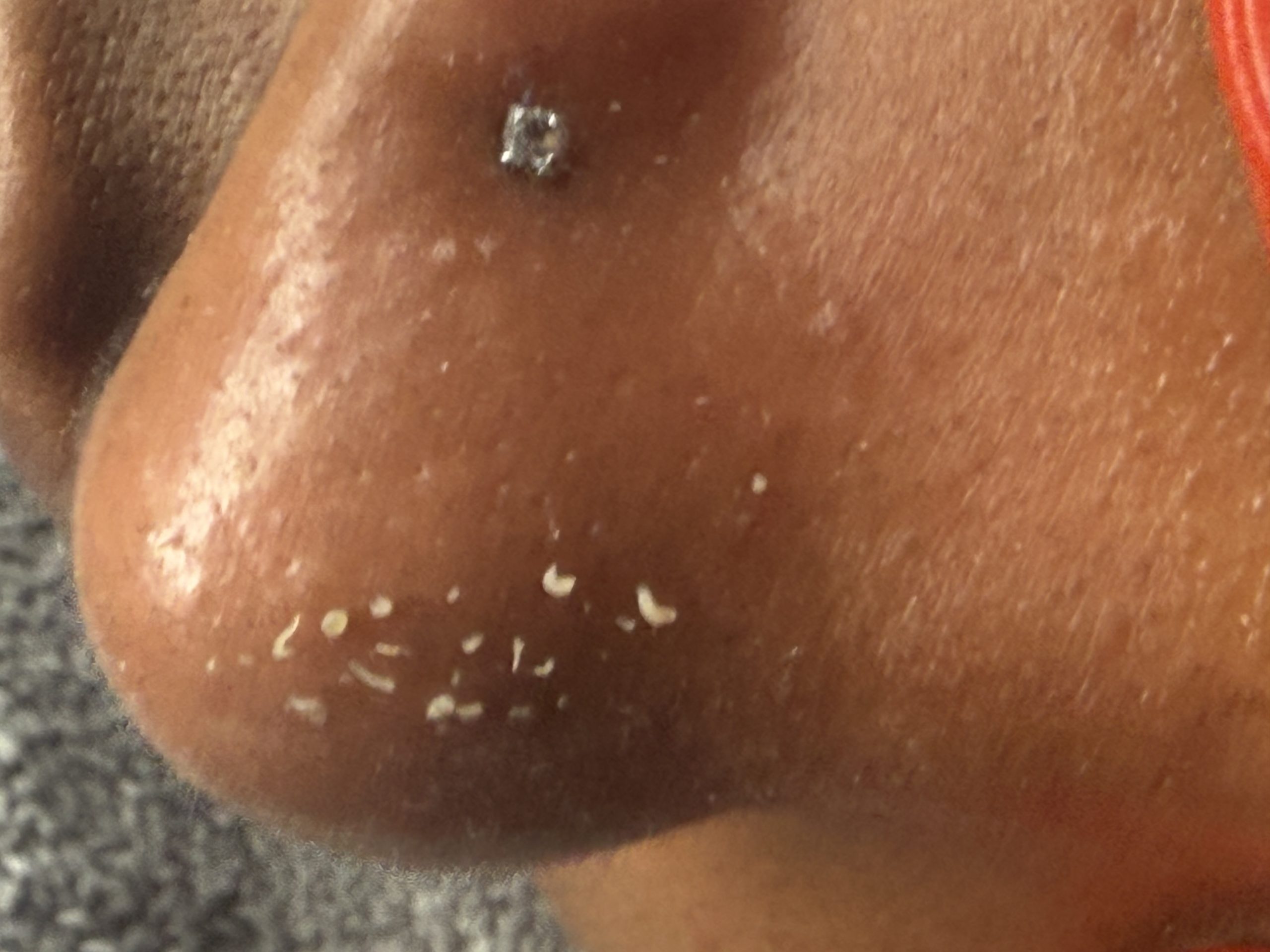 Deep extraction of clogged pores with sebum removal -facial treatment at Venus Spa Boston