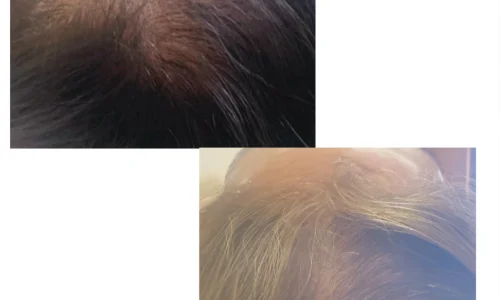 KeraLase Patient B&A