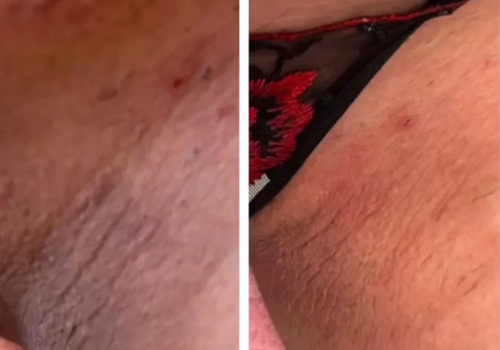 vi- peel-body-before-after-east-boston