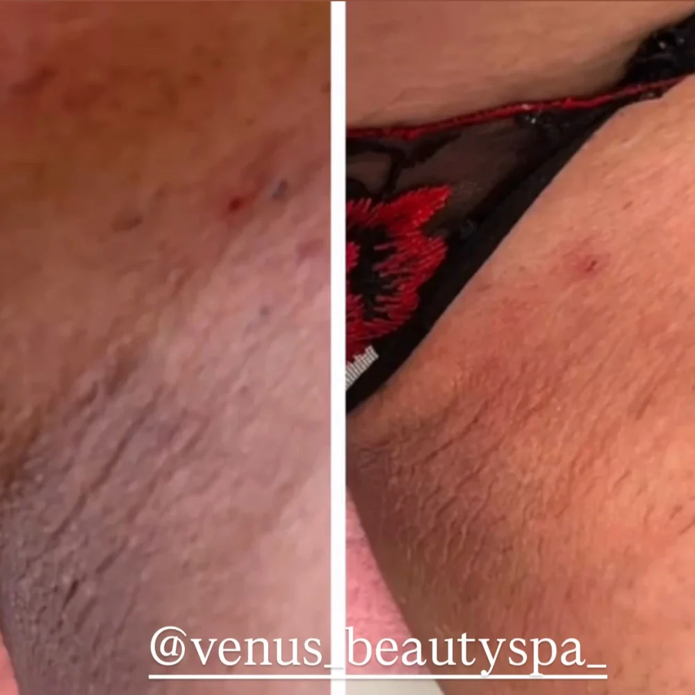 vi- peel-body-before-after-east-boston