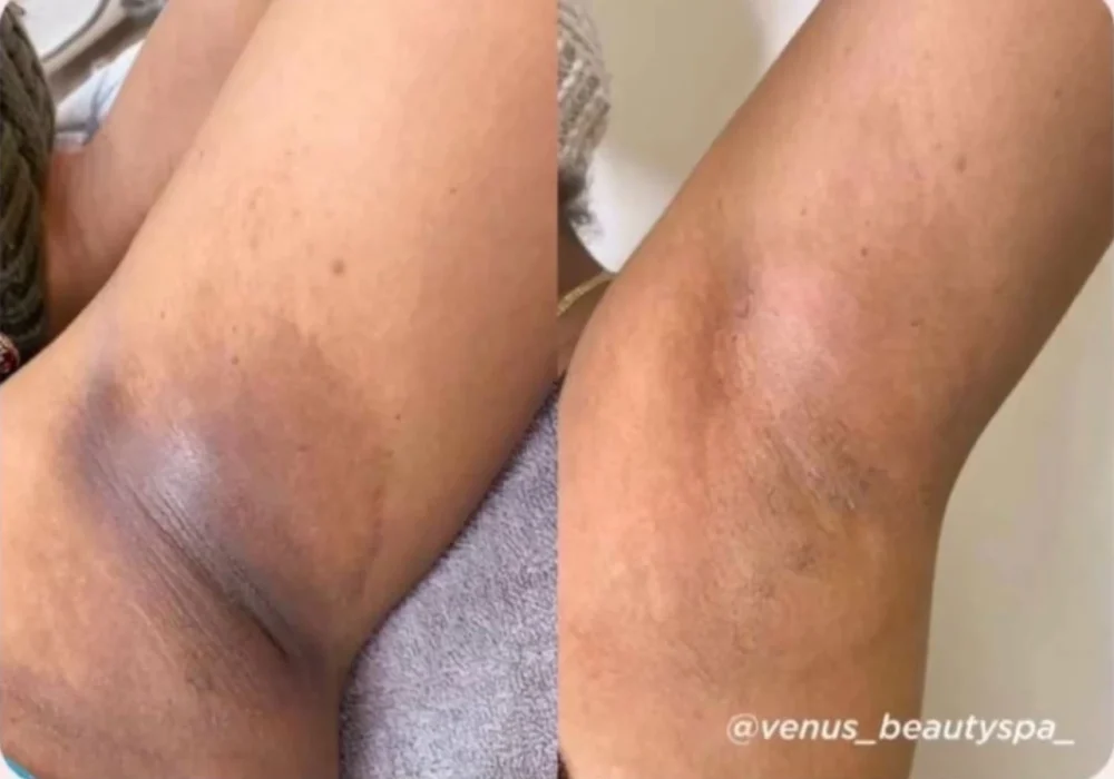 vi- peel-body-before-after-east-boston