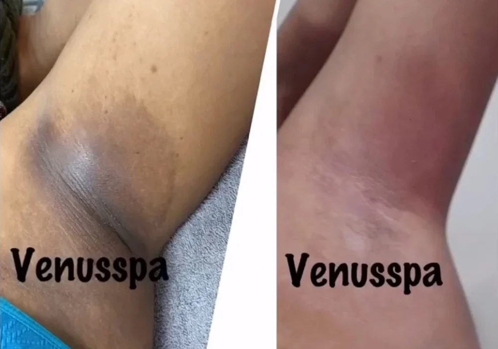 vi- peel-body-before-after-east-boston
