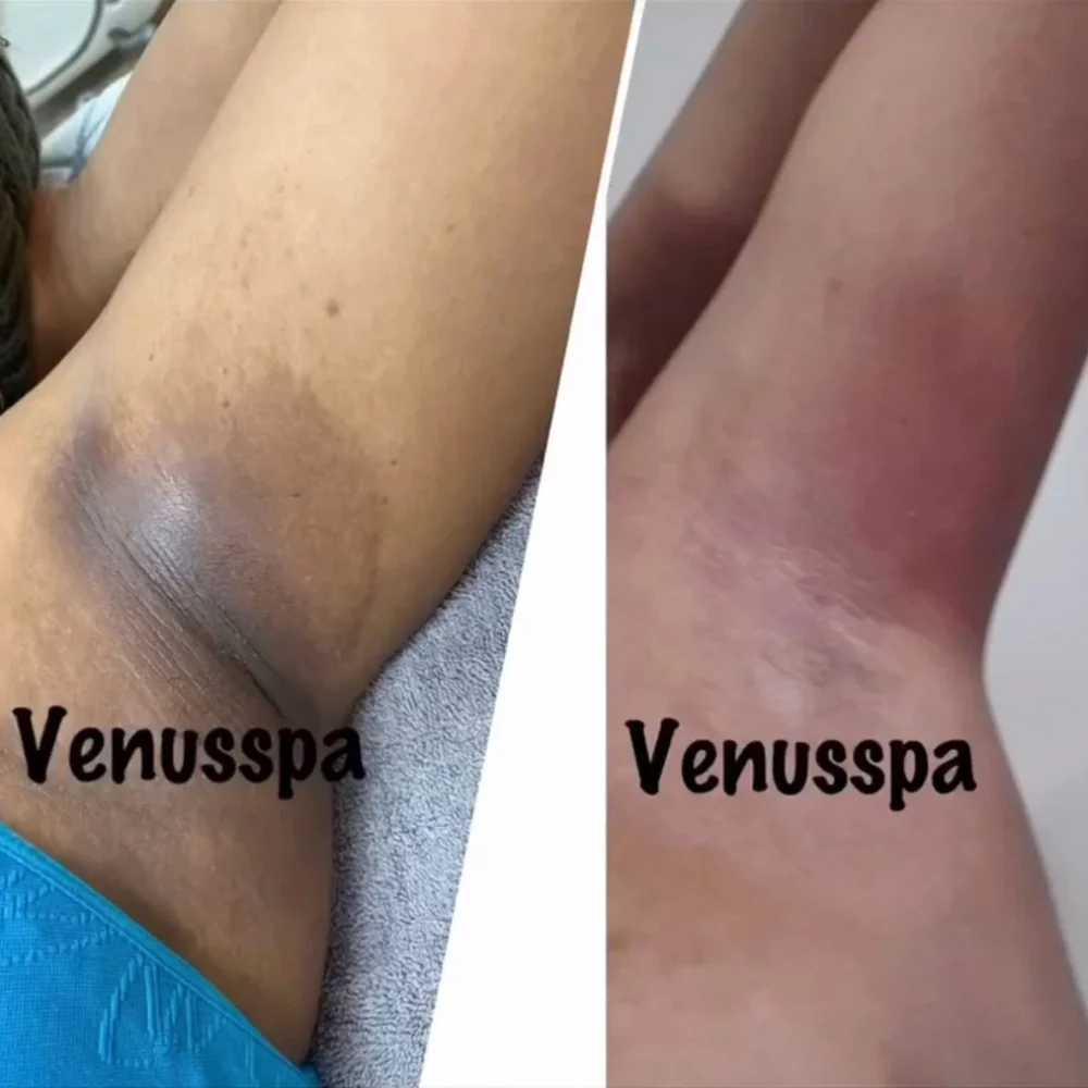 vi- peel-body-before-after-east-boston