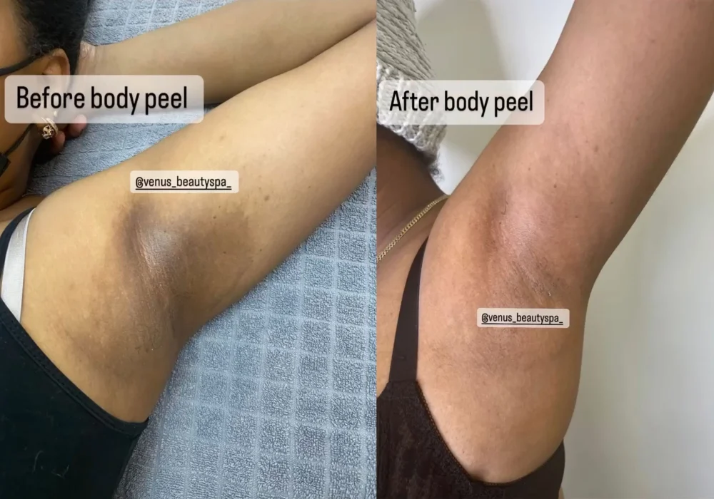 vi- peel-body-before-after-east-boston