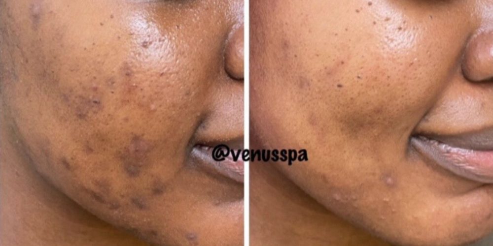 Chemical Peel Patient 5