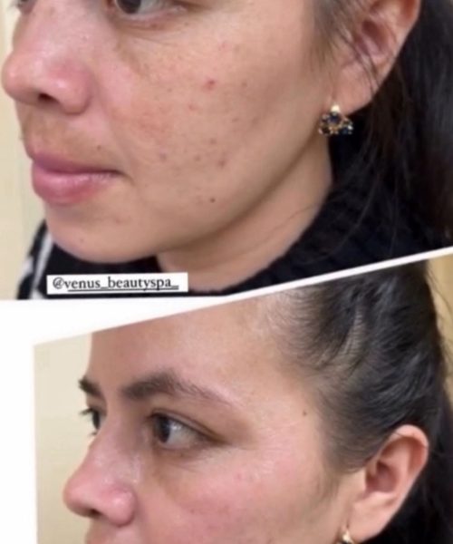 Chemical Peel Patient