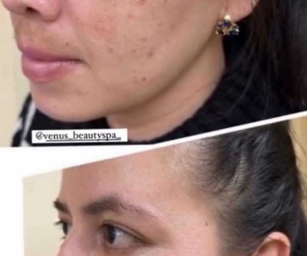 Chemical Peel Patient