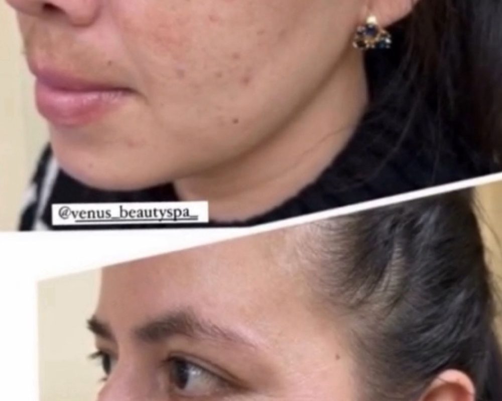 Chemical Peel Patient