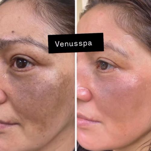 Chemical Peel Patient 2