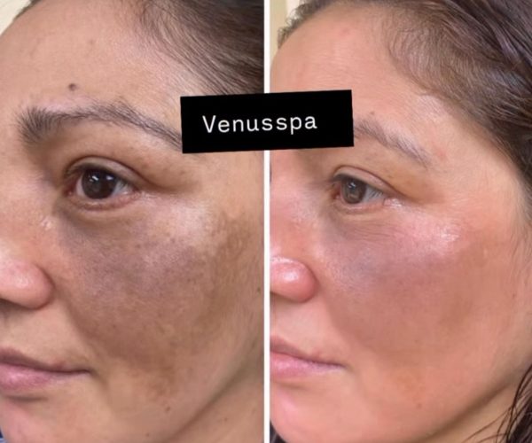 Chemical Peel Patient 2