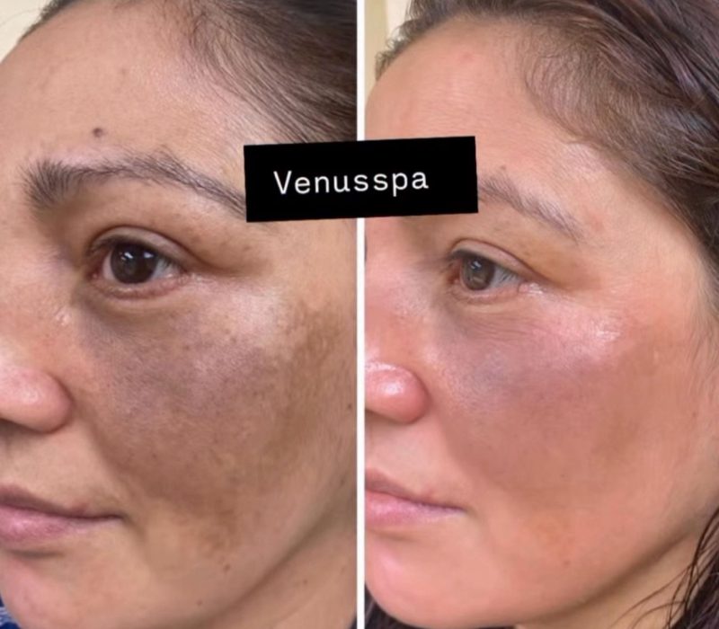 Chemical Peel Patient 2