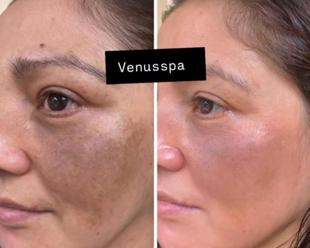 Chemical Peel Patient 2