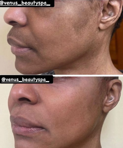 Chemical Peel Patient 4