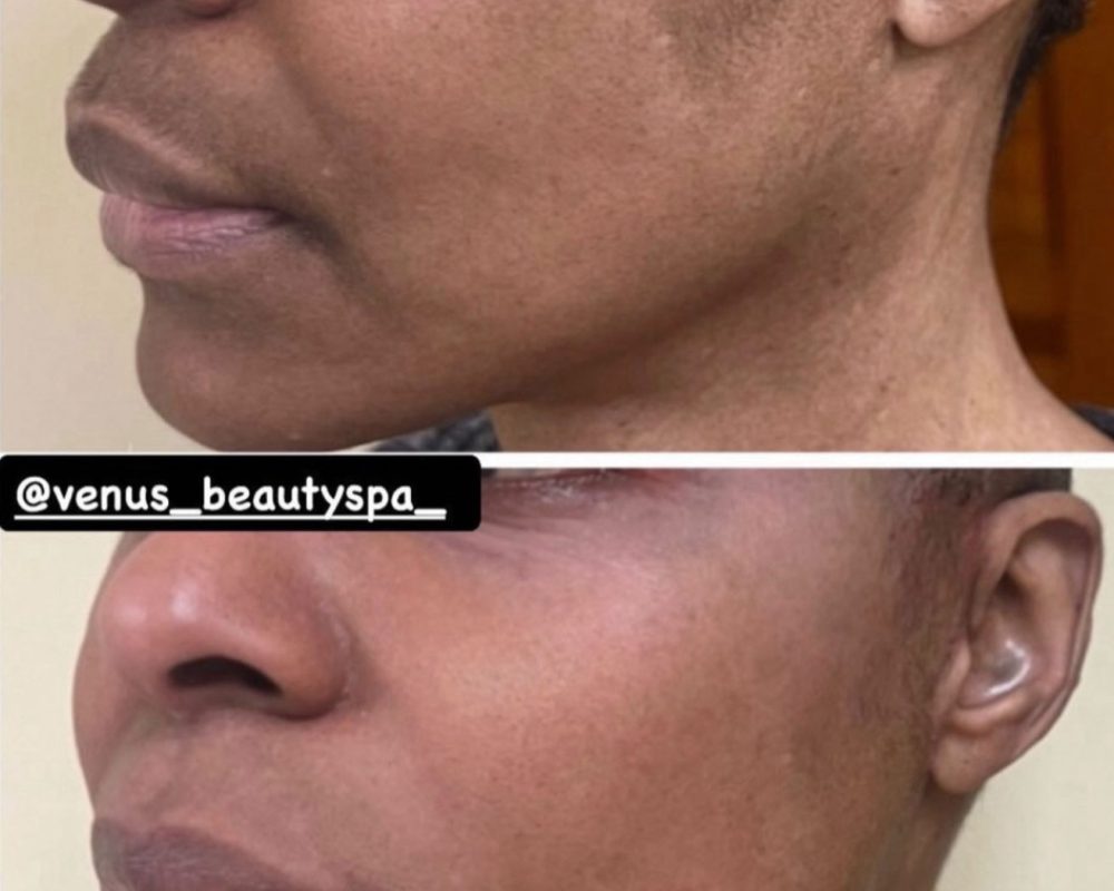 Chemical Peel Patient 4