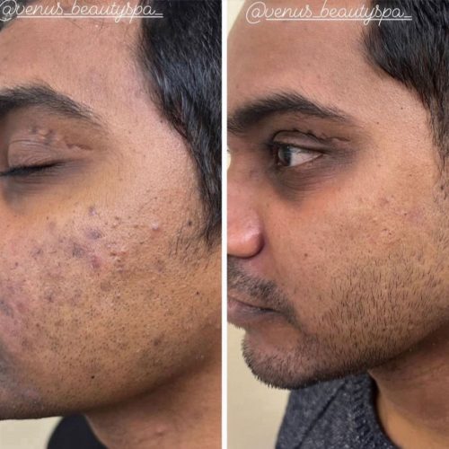 Chemical Peel for Acne Scars Before and After