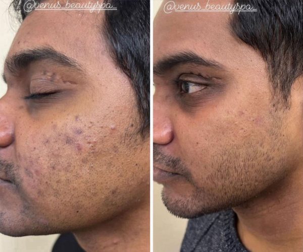Chemical Peel for Acne Scars Before and After