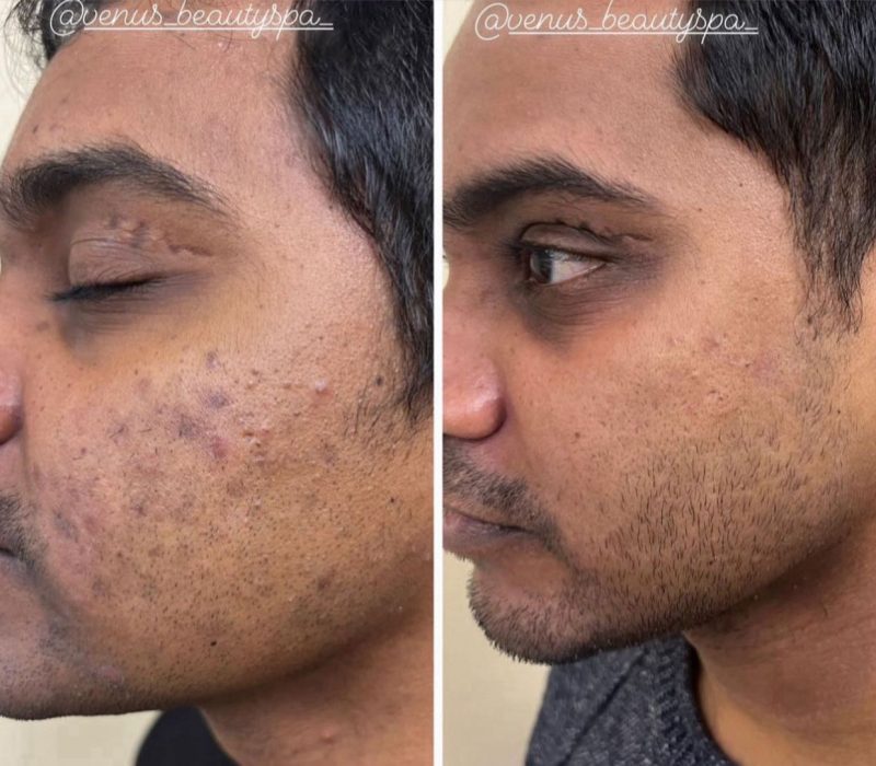 Chemical Peel for Acne Scars Before and After