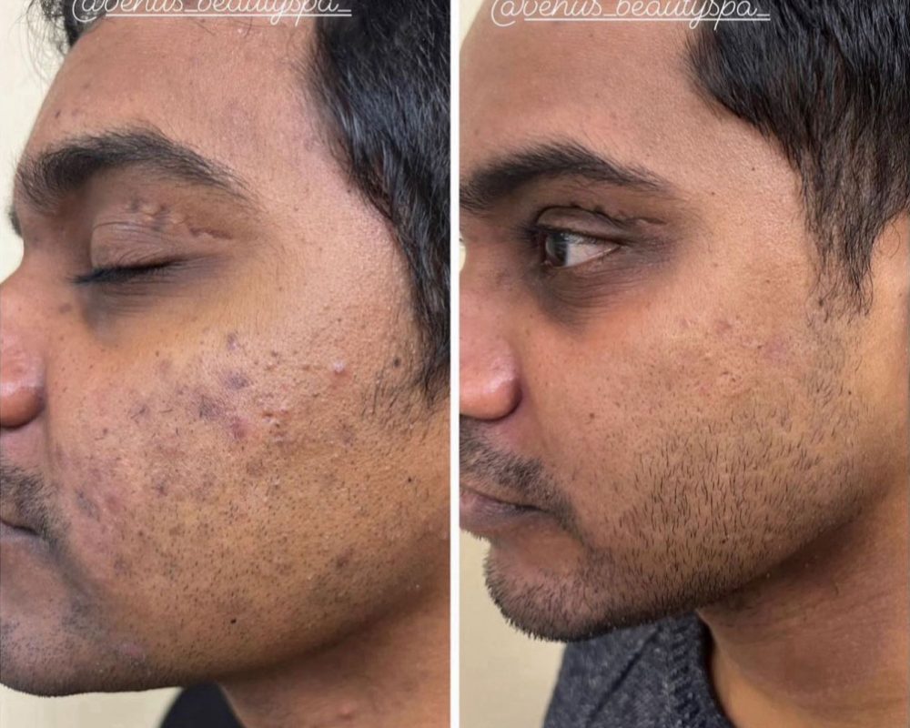 Chemical Peel for Acne Scars Before and After