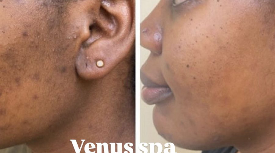 Chemical Peel Patient 6