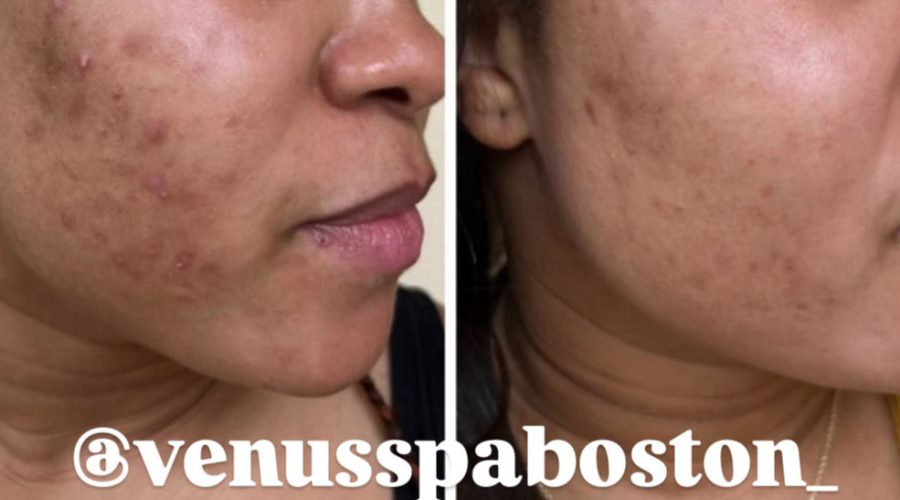 Chemical Peel for Acne Scars Before and After