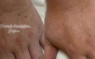 Chemical Peel Patient 8