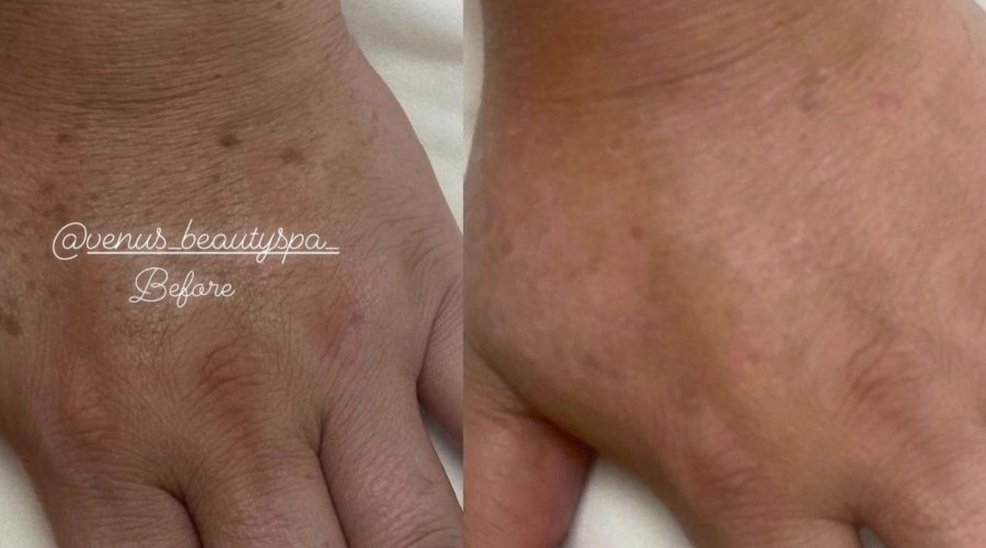 Chemical Peel Patient 8