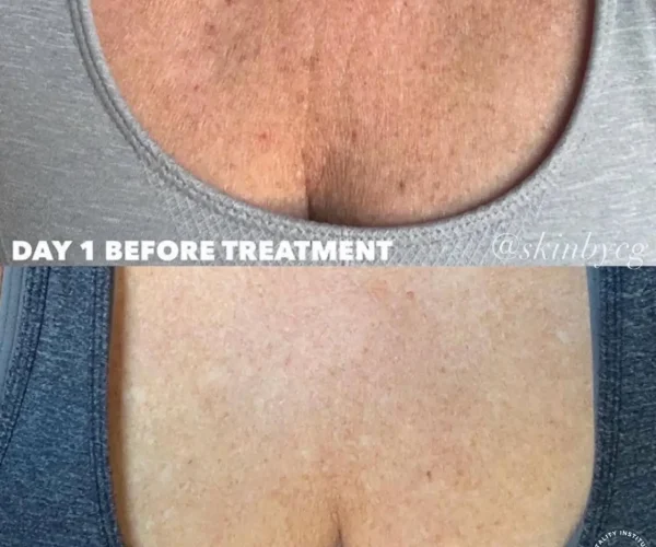 Chest Rejuvenation Patient B&A