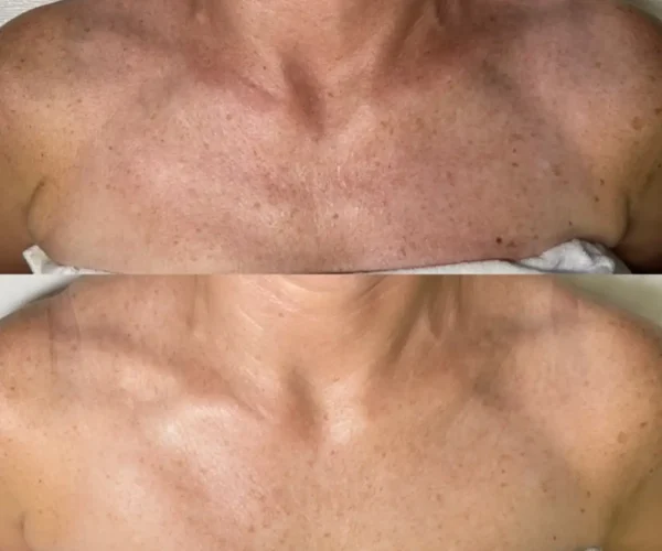 Chest Rejuvenation Patient B&A