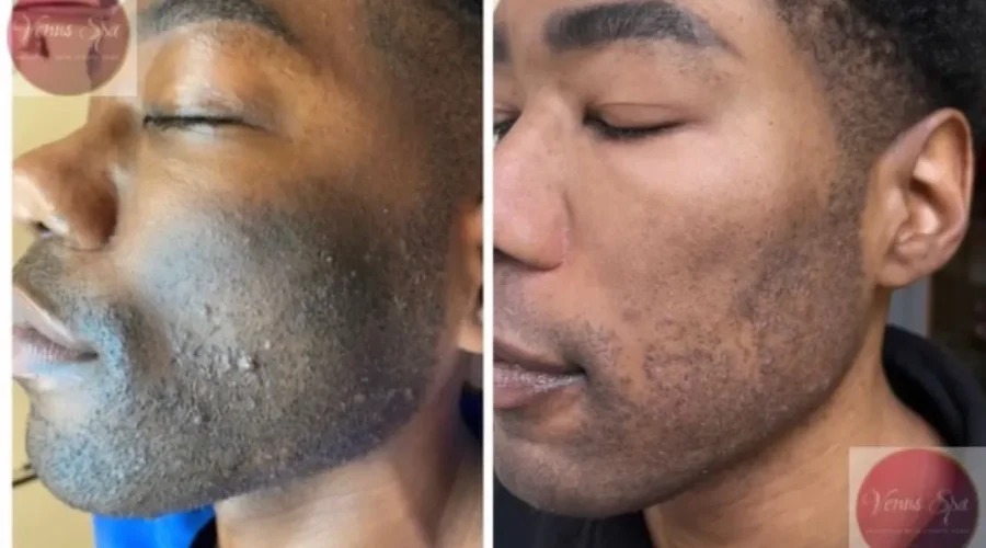 Enlighten™ Peel Patient