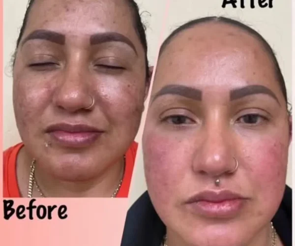 Enlighten™ Peel Patient