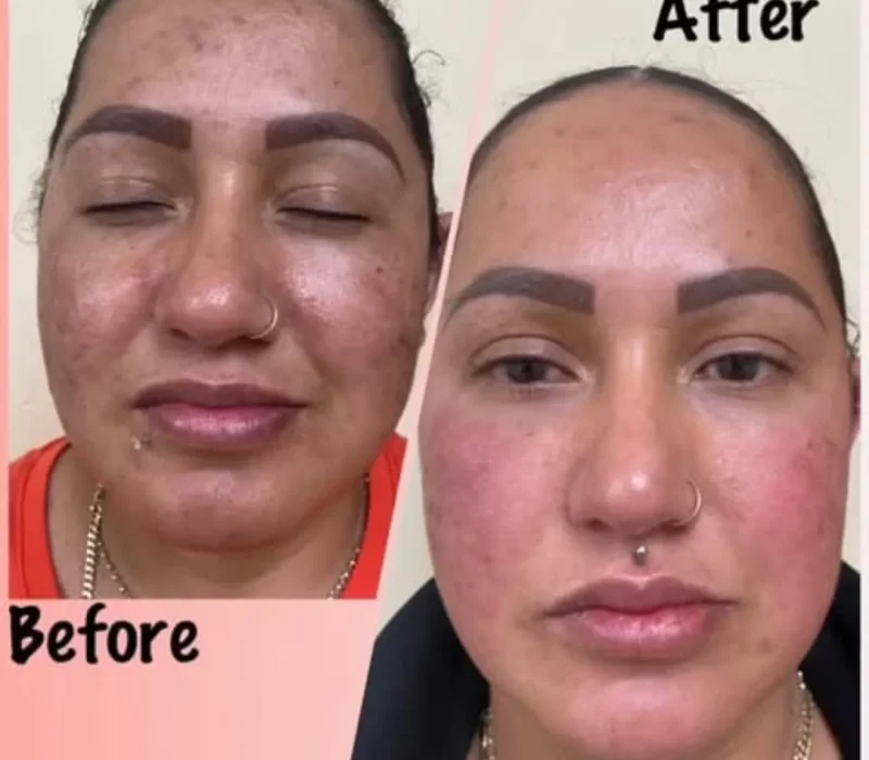 Enlighten™ Peel Patient