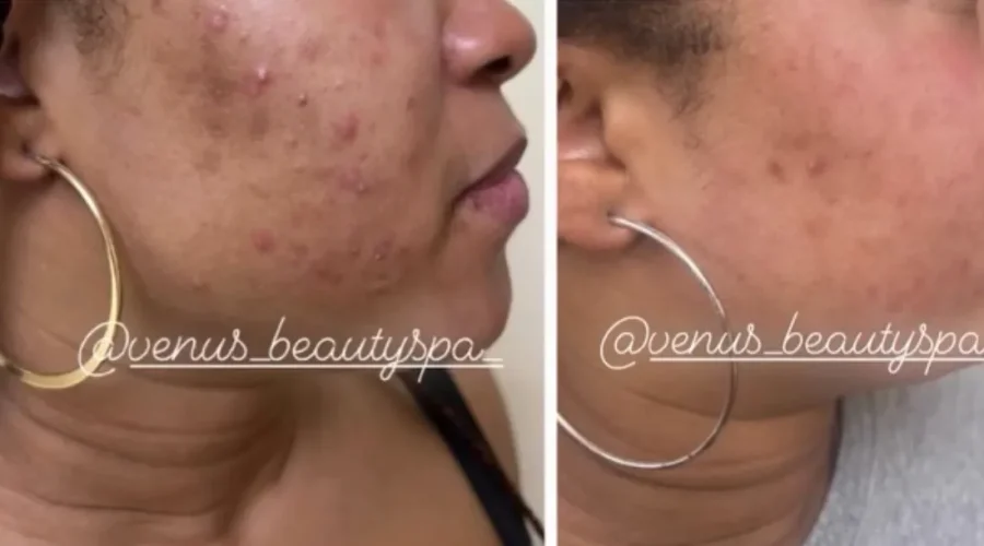 Enlighten™ Peel Patient