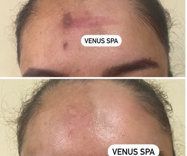 Enlighten™ Peel Patient