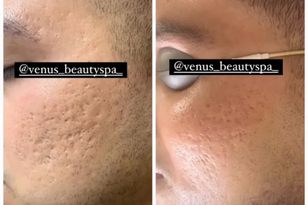 Fraxel Laser Patient