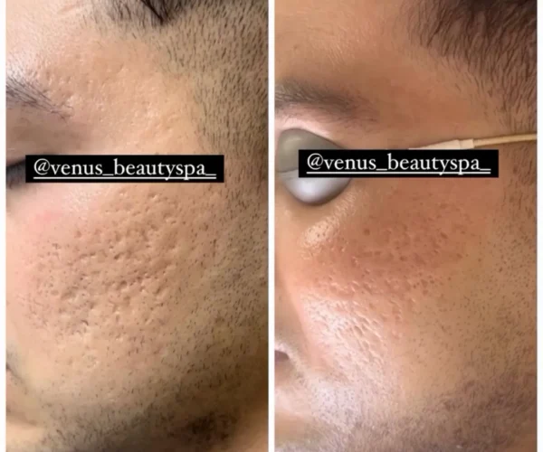 Fraxel Laser Patient