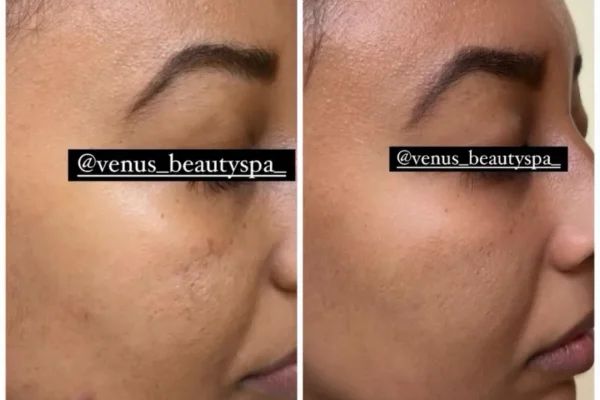 Fraxel Laser Patient