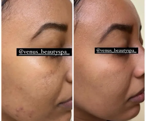 Fraxel Laser Patient