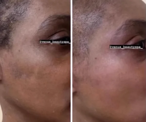 Enlighten™ Peel Patient