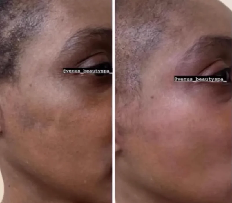 Enlighten™ Peel Patient