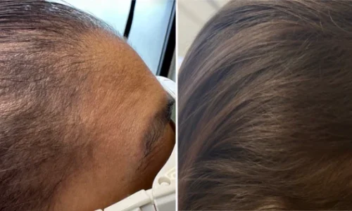 KeraLase Patient B&A