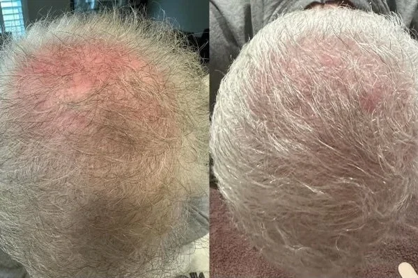 KeraLase Patient B&A